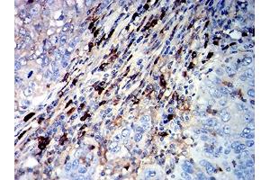 Immunohistochemical analysis of paraffin-embedded cervical cancer tissues using CD45R mouse mAb with DAB staining. (CD45 antibody  (AA 378-577))