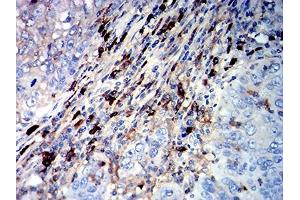 Immunohistochemical analysis of paraffin-embedded cervical cancer tissues using CD45R mouse mAb with DAB staining. (CD45 antibody  (AA 378-577))