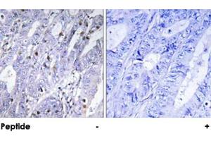 Immunohistochemical analysis of paraffin-embedded human colon carcinoma tissue using MEF2D polyclonal antibody . (MEF2D antibody)