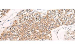 Immunohistochemistry of paraffin-embedded Human prost at e cancer tissue using C14orf2 Polyclonal Antibody at dilution of 1:60(x200) (C14orf2 antibody)