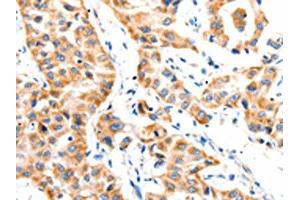 The image on the left is immunohistochemistry of paraffin-embedded Human lung cancer tissue using ABIN7191765(PAFAH1B1 Antibody) at dilution 1/25, on the right is treated with synthetic peptide. (PAFAH1B1 antibody)