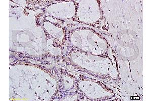 Formalin-fixed and paraffin embedded: human colon carcinoma labeled with Anti-MTLC Polyclonal Antibody (ABIN728015), Unconjugated at 1:200, followed by conjugation to the secondary antibody and DAB staining (Myc Target 1 antibody  (AA 21-100))