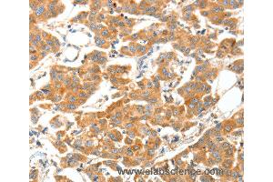 Immunohistochemistry of Human cervical cancer using ADAMTS18 Polyclonal Antibody at dilution of 1:30