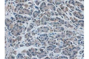 IHC-P analysis of Human Pancreas Cancer Tissue, with DAB staining. (IDE antibody  (AA 753-973))
