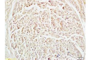 Formalin-fixed and human rectal carcinoma tissue labeled with Anti-Alpha-Adaptin Polyclonal Antibody, Unconjugated  at 1:200 followed by conjugation to the secondary antibody and DAB staining