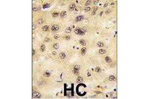 Formalin-fixed and paraffin-embedded human hepatocarcinoma tissue reacted with PROX1 antibody (Center), which was peroxidase-conjugated to the secondary antibody, followed by DAB staining. (PROX1 antibody  (AA 185-214))