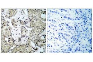 Immunohistochemical analysis of paraffin- embedded human breast carcinoma tissue, using MKK3 (phospho-Ser189) antibody (E011145). (MAP2K3 antibody  (pSer189))