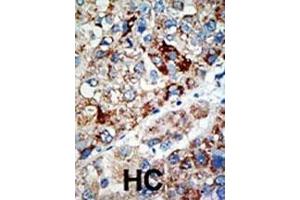 Formalin-fixed and paraffin-embedded human cancer tissue reacted with the primary antibody, which was peroxidase-conjugated to the secondary antibody, followed by AEC staining. (USP21 antibody  (N-Term))