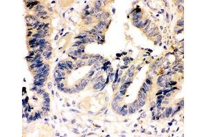 IHC-P: Caspase-7 antibody testing of human intestinal cancer tissue (Caspase 7 antibody  (AA 237-255))