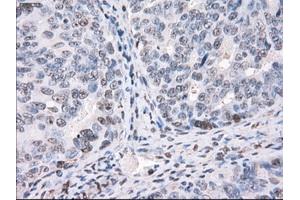 Immunohistochemical staining of paraffin-embedded Adenocarcinoma of colon tissue using anti-PPP5Cmouse monoclonal antibody. (PP5 antibody)