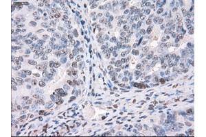 Immunohistochemical staining of paraffin-embedded Adenocarcinoma of colon tissue using anti-PPP5Cmouse monoclonal antibody. (PP5 antibody)