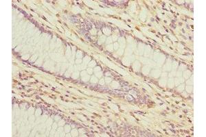 Immunohistochemistry of paraffin-embedded human colon cancer using ABIN7158367 at dilution of 1:100 (LMO4 antibody  (AA 1-165))