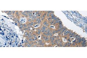 Immunohistochemistry of paraffin-embedded Human colorectal cancer tissue using RTN4IP1 Polyclonal Antibody at dilution of 1:50(x200)
