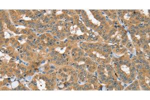 Immunohistochemistry of paraffin-embedded Human thyroid cancer using SEC14L2 Polyclonal Antibody at dilution of 1:40 (SEC14L2 antibody)