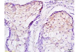 Formalin-fixed and paraffin embedded human scalp labeled with Rabbit Anti JNK2 Polyclonal Antibody, Unconjugated (ABIN681403) at 1:200 followed by conjugation to the secondary antibody and DAB staining (JNK1/2 antibody  (AA 311-424))