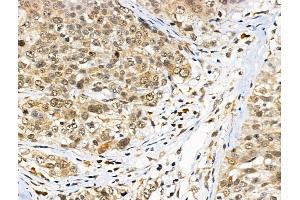 ABIN6260147 and ABIN6266767 at 1/100 staining Human pancreatic cancer by IHC-P.