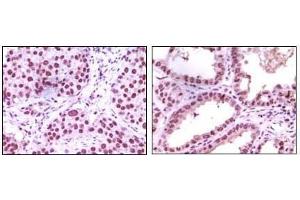 Immunohistochemical analysis of paraffin-embedded human lung carcinoma (left) and kidney carcinoma (right), showing nuclear localization using LSD1 antibody with DAB staining.