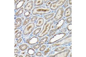 Immunohistochemistry of paraffin-embedded human liver cancer using GAPDH Mouse mAb (ABIN3020540, ABIN3020541, ABIN3020542 and ABIN1512934) at dilution of 1:100 (40x lens). (GAPDH antibody)