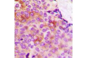 Immunohistochemical analysis of DARPP32 (pT75) staining in human breast cancer formalin fixed paraffin embedded tissue section.