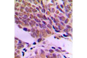 Immunohistochemical analysis of ATF2 staining in human breast cancer formalin fixed paraffin embedded tissue section.