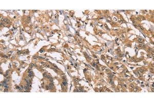 Immunohistochemistry of paraffin-embedded Human colon cancer using PEBP1 Polyclonal Antibody at dilution of 1:40 (PEBP1 antibody)