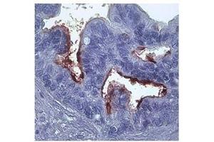 MMP1 in epithelial cells ovarian carcinoma was detected using HRP/DAB brown color stain. (MMP1 antibody)
