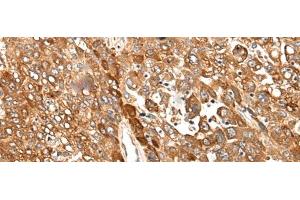 Immunohistochemistry of paraffin-embedded Human liver cancer tissue using CAD Polyclonal Antibody at dilution of 1:50(x200) (CAD antibody)