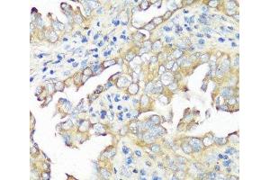 Immunohistochemistry of paraffin-embedded Human lung cancer using EIF3B Polyclonal Antibody at dilution of 1:100 (40x lens). (EIF3B antibody)