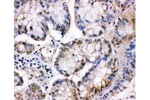 Anti-MCM5 antibody, IHC(P) IHC(P): Human Intestinal Cancer Tissue (MCM5 antibody  (C-Term))
