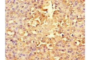 Immunohistochemistry of paraffin-embedded human breast cancer using ABIN7142567 at dilution of 1:100 (RPS6 antibody  (AA 35-229))