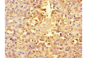 Immunohistochemistry of paraffin-embedded human breast cancer using ABIN7142567 at dilution of 1:100 (RPS6 antibody  (AA 35-229))