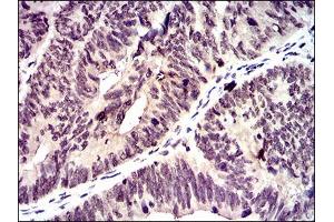 Immunohistochemical analysis of paraffin-embedded rectum cancer tissues using ID2 mouse mAb with DAB staining. (Id2 antibody  (AA 1-134))