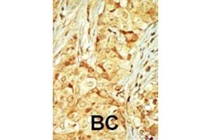 Formalin-fixed and paraffin-embedded human cancer tissue reacted with the primary antibody, which was peroxidase-conjugated to the secondary antibody, followed by DAB staining. (MOK antibody  (C-Term))