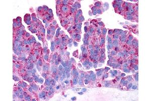 Anti-PAEL Receptor / GPR37 antibody IHC of human Ovary, Carcinoma.
