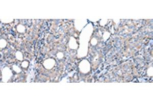 Immunohistochemistry of paraffin-embedded Human thyroid cancer tissue using FKBPL Polyclonal Antibody at dilution of 1:50(x200) (FKBPL antibody)