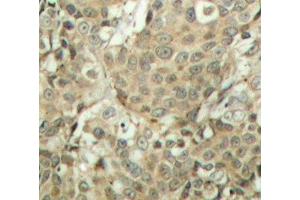 Immunohistochemistry of paraffin-embedded Human breast carcinoma tissue, using Phospho-CFL1(S3) Polyclonal Antibody (Cofilin antibody  (pSer3))