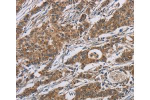 Immunohistochemistry of Human gastric cancer using AGER Polyclonal Antibody at dilution of 1:70 (RAGE antibody)