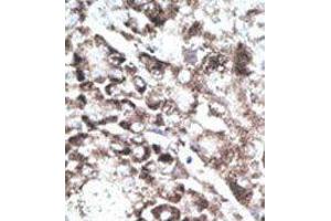 Formalin-fixed and paraffin-embedded human cancer tissue reacted with the primary antibody, which was peroxidase-conjugated to the secondary antibody, followed by DAB staining. (GPR37 antibody  (C-Term))