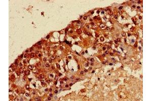 Immunohistochemistry of paraffin-embedded human breast cancer using ABIN7159273 at dilution of 1:100 (MAGEA8 antibody  (AA 1-270))