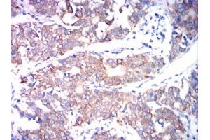 Immunohistochemical analysis of paraffin-embedded cervical cancer tissues using ADAM10 mouse mAb with DAB staining. (ADAM10 antibody)