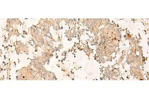 Immunohistochemistry of paraffin-embedded Human lung cancer tissue using TEX11 Polyclonal Antibody at dilution of 1:30(x200) (TEX11 antibody)