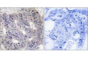Immunohistochemistry analysis of paraffin-embedded human colon carcinoma tissue, using ES8L1 Antibody. (EPS8-Like 1 antibody  (AA 411-460))