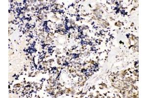 IHC testing of FFPE human lung cancer tissue with TRF2 antibody at 1ug/ml.