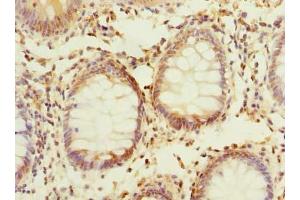 Immunohistochemistry of paraffin-embedded human colon cancer using ABIN7163353 at dilution of 1:100 (PPAP2C antibody  (AA 109-162))