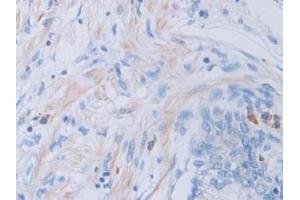 Detection of CTSV in Human Prostate Tissue using Polyclonal Antibody to Cathepsin V (CTSV) (Cathepsin L2 antibody  (AA 64-334))