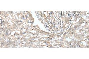 Immunohistochemistry of paraffin-embedded Human lung cancer tissue using VILL Polyclonal Antibody at dilution of 1:65(x200) (VILL antibody)