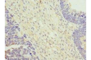 Immunohistochemistry of paraffin-embedded human ovarian cancer using ABIN7175314 at dilution of 1:100 (VPS35 antibody  (AA 1-250))