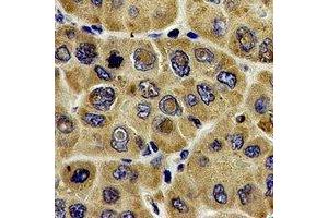 Immunohistochemical analysis of DLD staining in human liver cancer formalin fixed paraffin embedded tissue section. (DLD antibody)