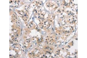 Immunohistochemical analysis of paraffin-embedded Human thyroid cancer tissue using at dilution 1/25. (CTAG1A antibody  (Internal Region))
