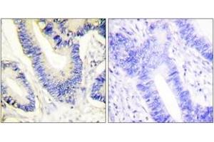 Immunohistochemistry analysis of paraffin-embedded human colon carcinoma tissue, using IRS-1 (Ab-612) Antibody. (IRS1 antibody  (AA 578-627))